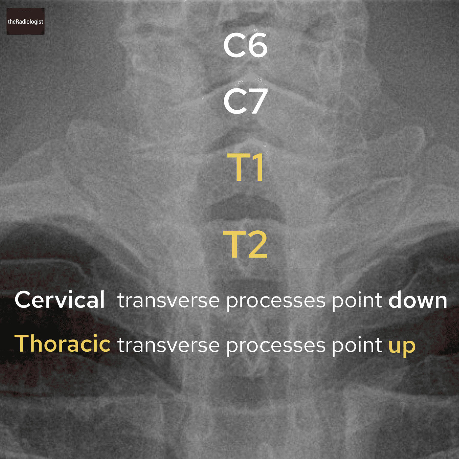 Transverse Process Radiograph Anatomy quiz 2 - the Radiologist