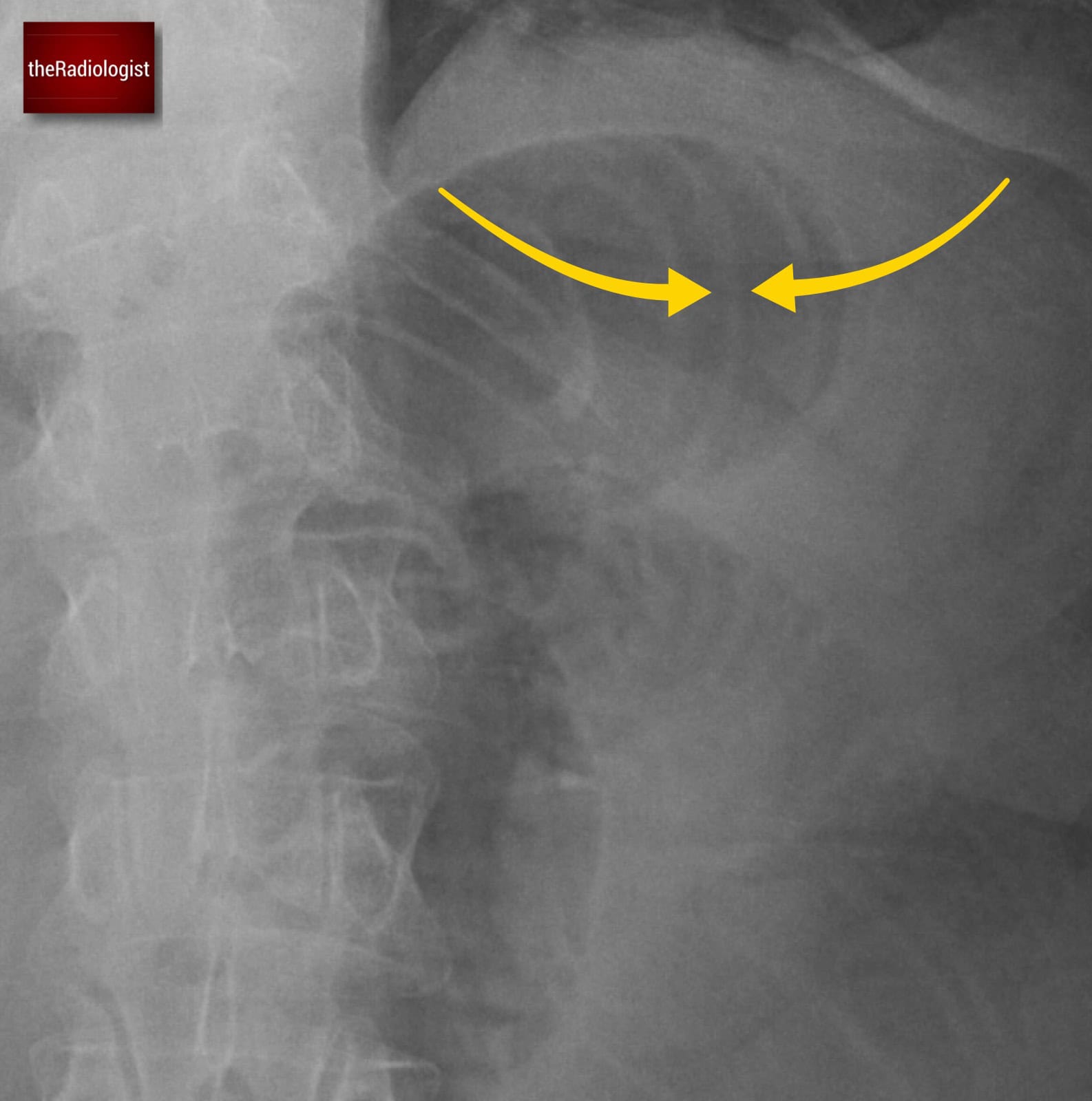 Valvulae How to Read an Abdominal X-ray | AXR Interpretation Guide