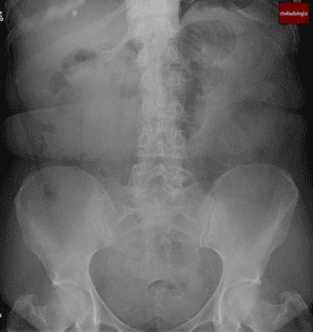 Acute Appendicitis CT Case | Dilated Appendix & Fat Stranding