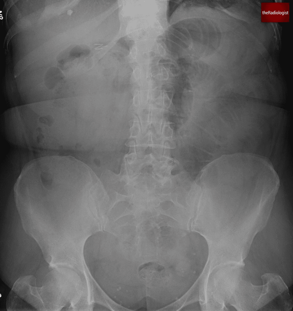 Obstructing Ureteric Calculi | CT Imaging Guide