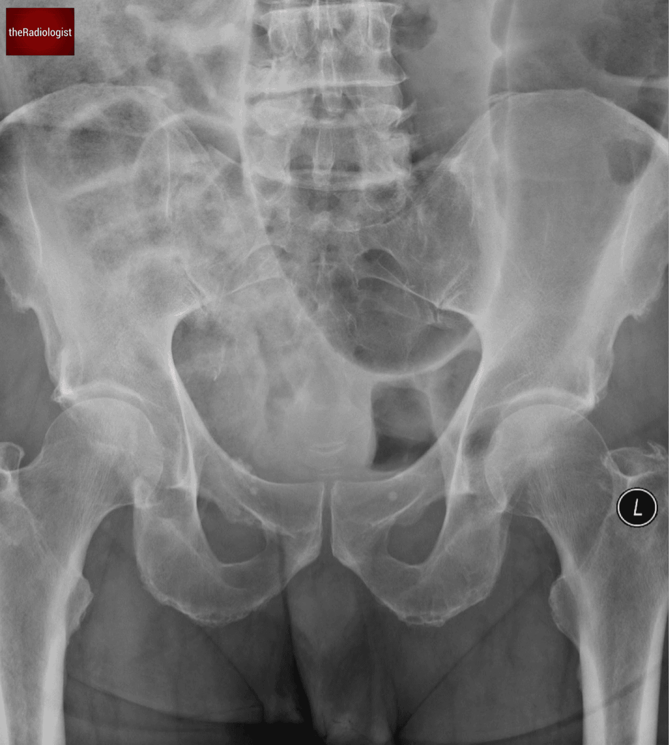 Volvulus Sigmoid volvulus - the Radiologist