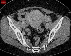 Multiple Lung Nodules The Radiologist