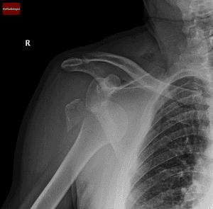 Dislocation X Ray Scan Shoulder Dislocation X-ray | Anterior Dislocation Signs