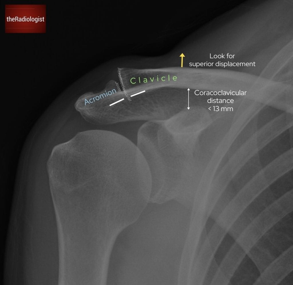 Volar plate injuries - the Radiologist