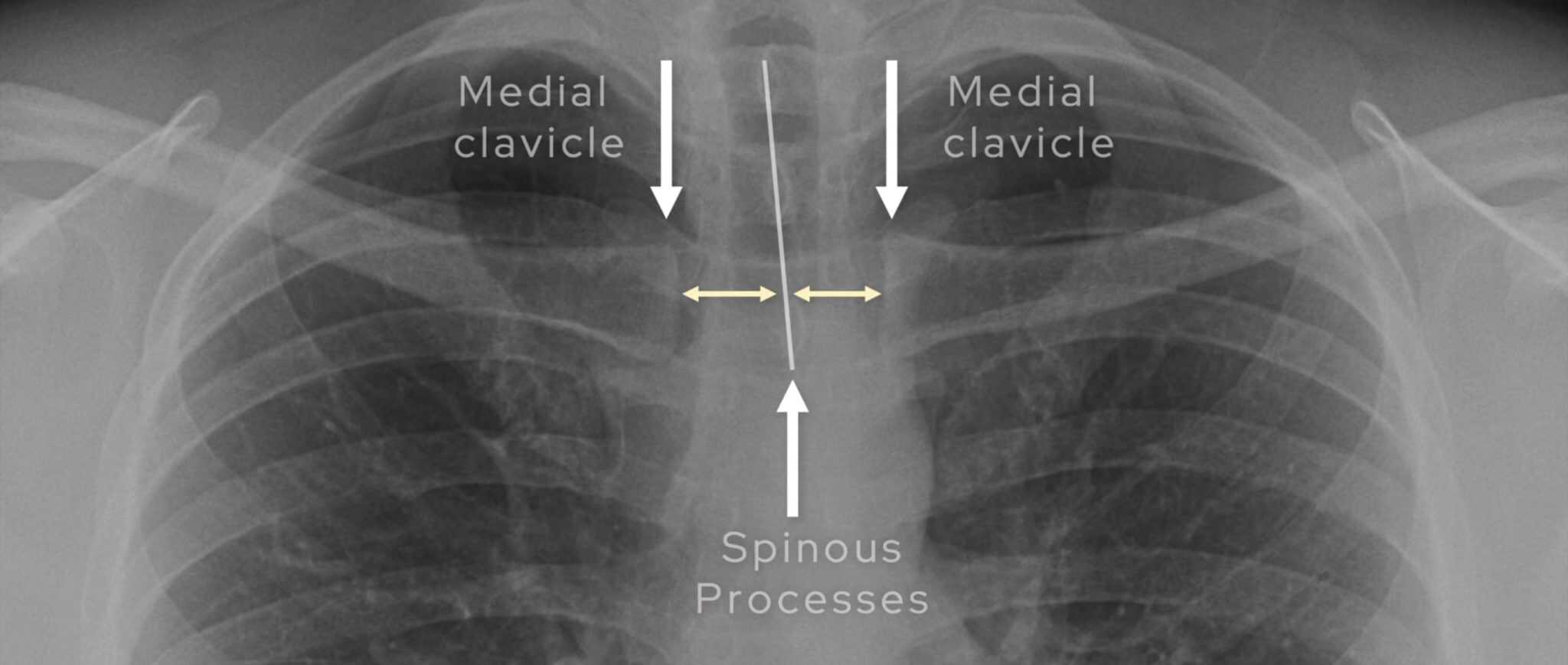 How to Read a Chest X-ray | CXR Interpretation Guide