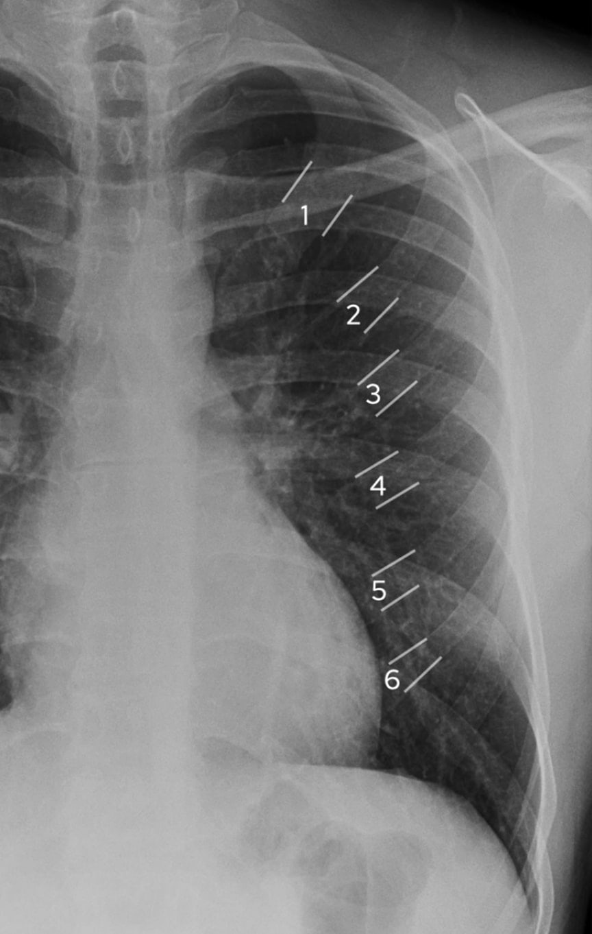 How to Read a Chest X-ray | CXR Interpretation Guide