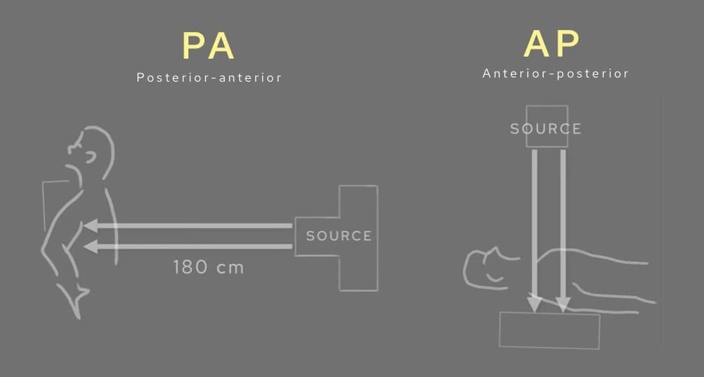 How to Read a Chest X-ray | CXR Interpretation Guide
