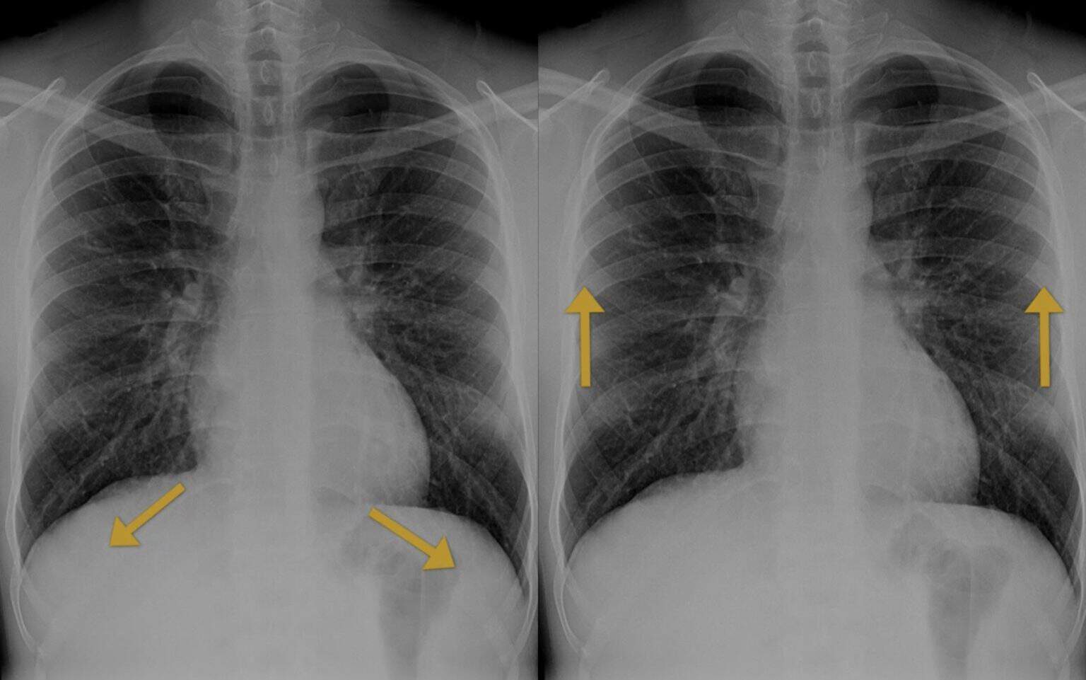 How to Read a Chest X-ray | CXR Interpretation Guide