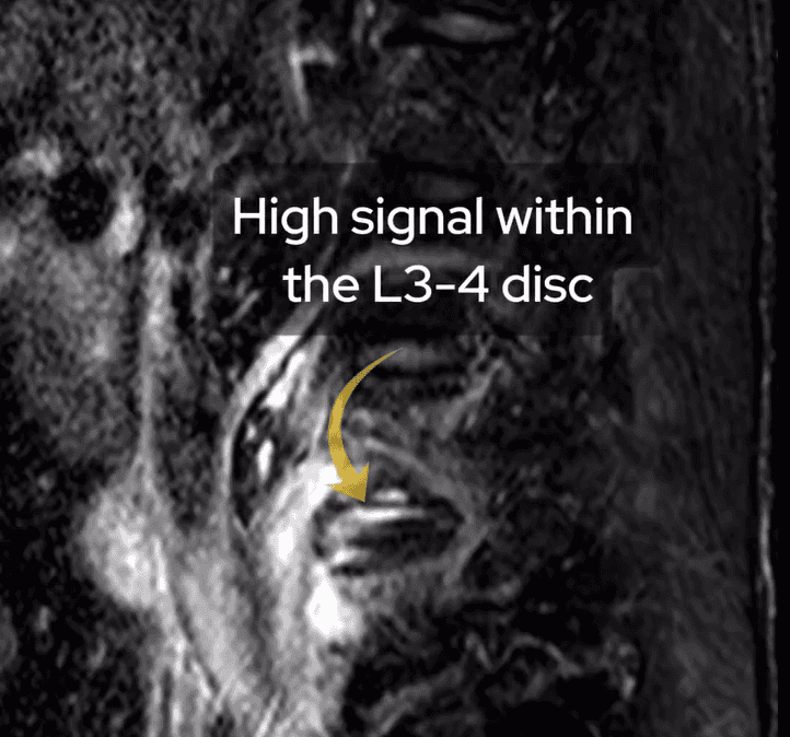 Image showing high signal within the L3-4 disc