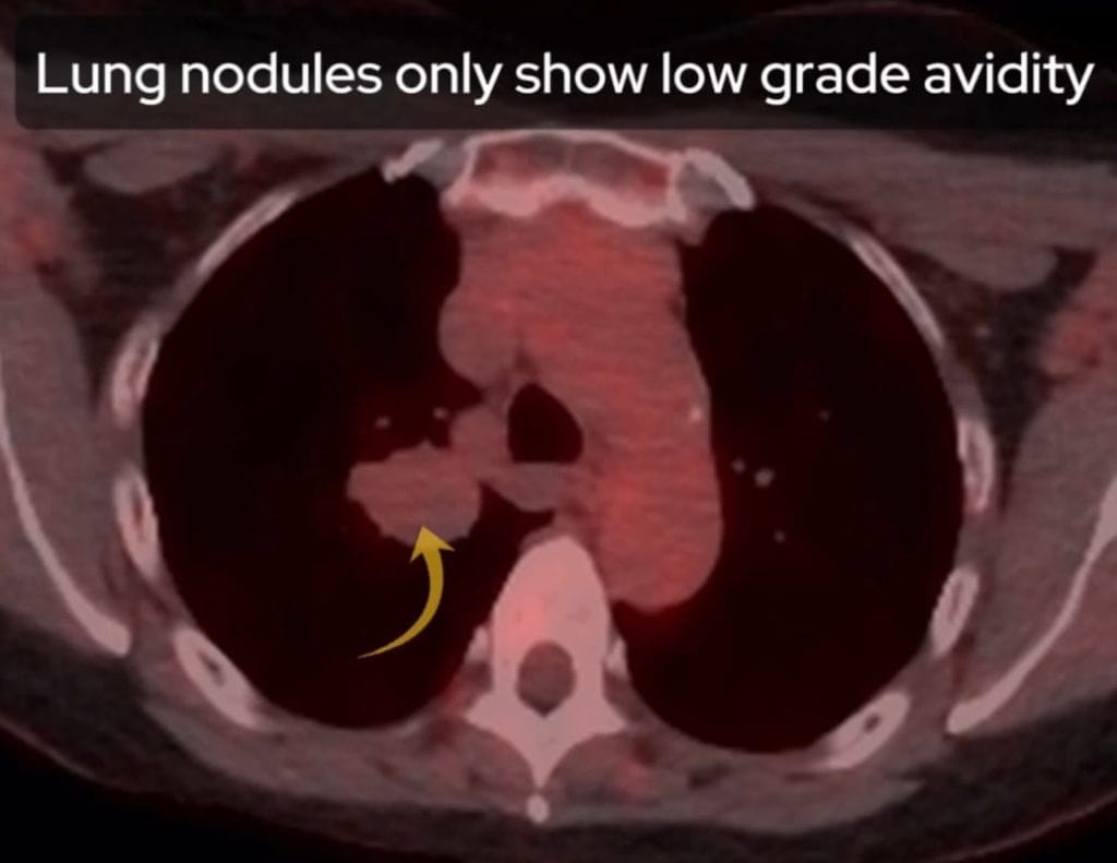 PET-CT showing lung nodules demonstrating low-grade FDG avidity.