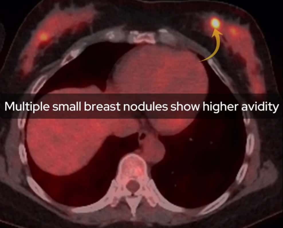 PET-CT image showing breast nodules with high FDG avidity.