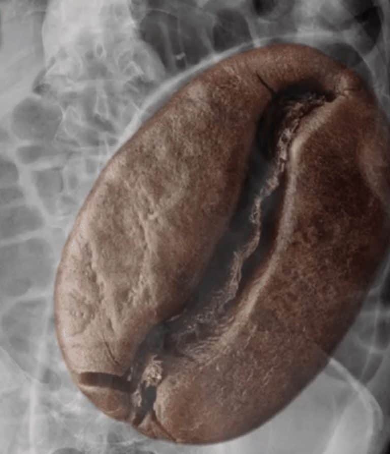 Abdominal X-ray showing sigmoid volvulus with a large coffee bean graphic superimposed over the dilated sigmoid colon to demonstrate the coffee bean sign.