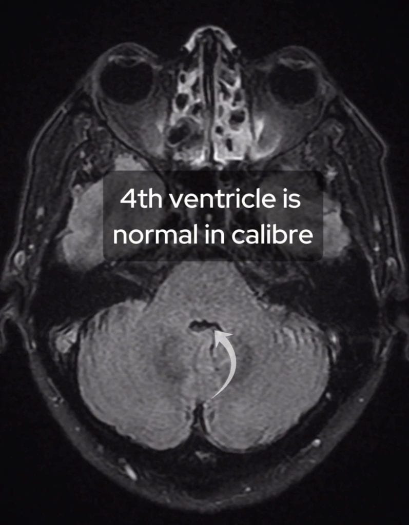 Axial FLAIR MRI of the brain showing a normal calibre fourth ventricle.