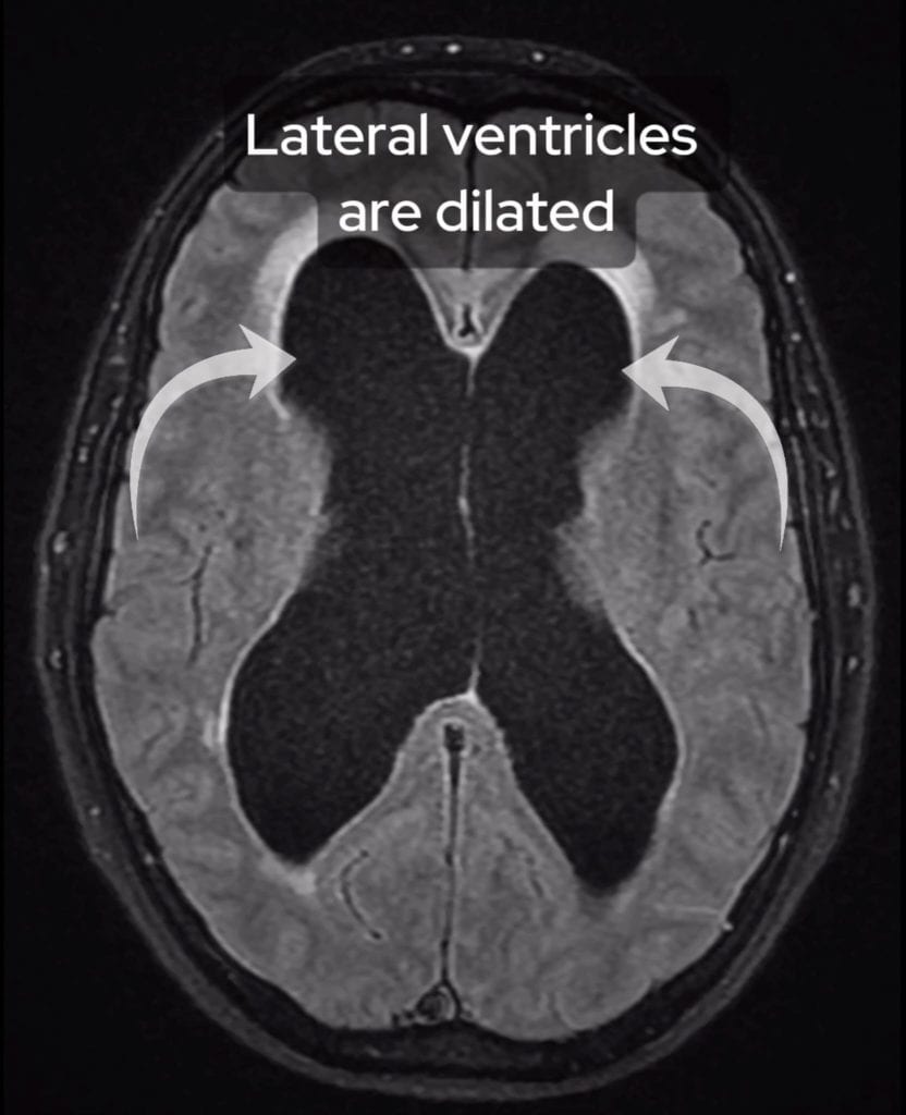 MRI scan of the brain with dilated lateral ventricles highlighted.